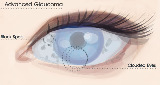 Glaucoma ridurre il rischio con l'attività fisica